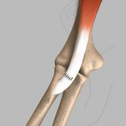 Distal Biceps Repair